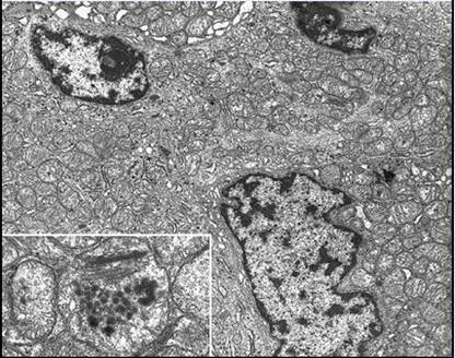 Photo of Abnormal mitochondria within a tumor